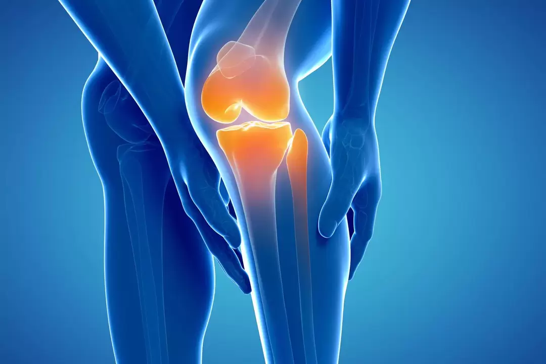 Artróza kolenního kloubu (gonartróza, deformující se osteoartróza)