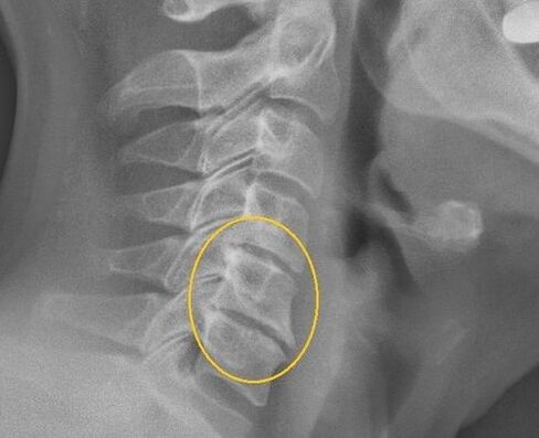 Osteochondrosis krční páteře na x -radě