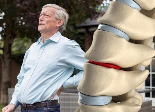Osteochondróza postihuje meziobratlové ploténky a způsobuje bolesti zad
